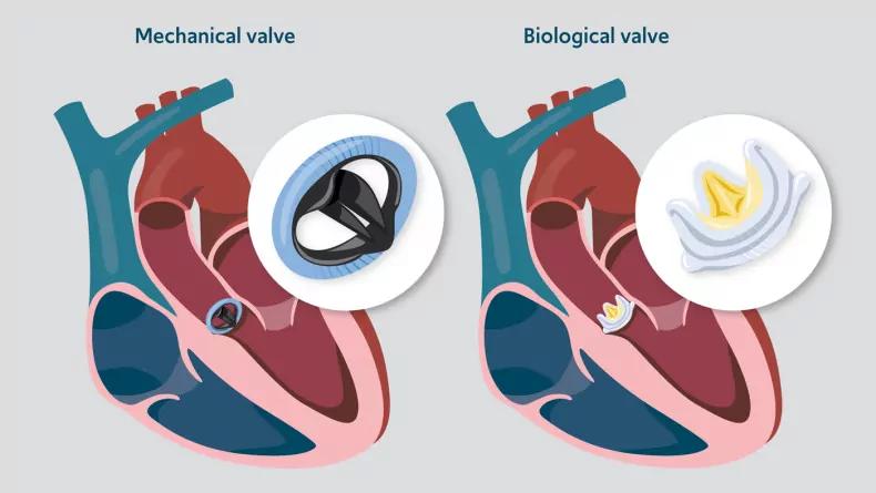 time–temperature-indicators-for-prosthetic-heart-valve-storage-and-transportation.jpg